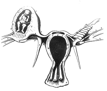 An ectopic pregnancy